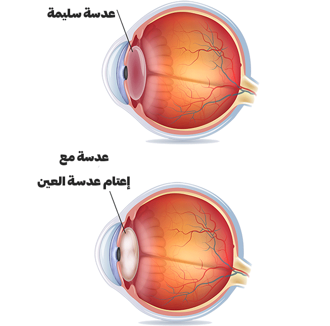 علاج العيون في ايران